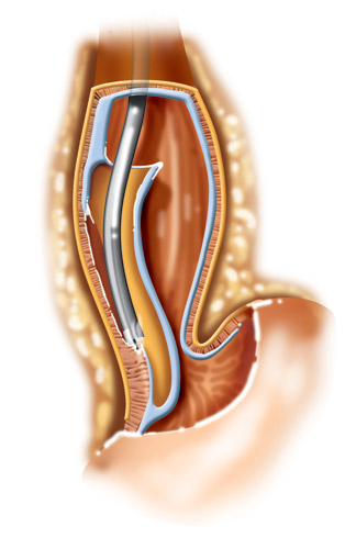 Fig 2. Esophageal achlasia